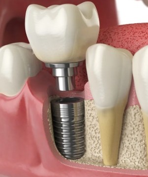 Dental Implants